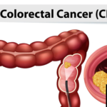 Colorectal Cancers new test
