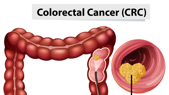 Colorectal Cancers new test